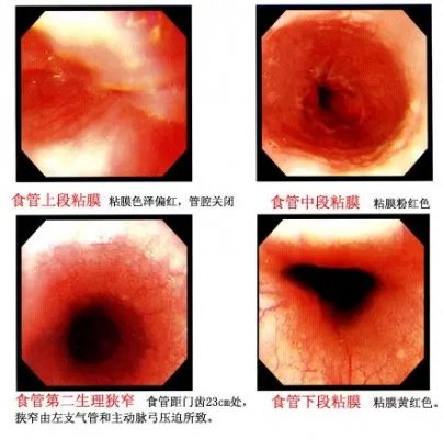 泉州做胃镜前要注意什么