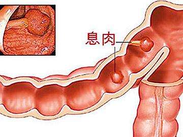 肠息肉到泉州哪家医院治疗